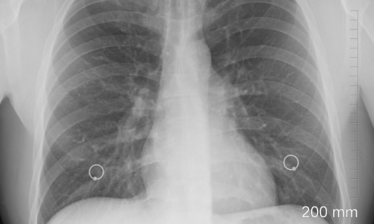 肺结节是什么？