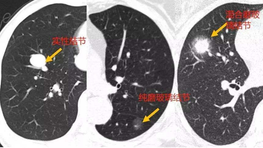 肺结节是什么？(图1)